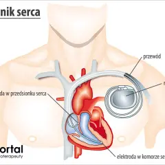 Wymiana rozrusznika serca: Co z baterią? Przewodnik i refundacja NFZ